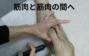 スーパーライザーを深部まで照射