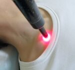 鎖骨へのメディチャーライト近赤外線照射