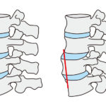 腰椎変位