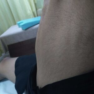 肉離れ