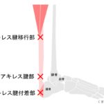 アキレス腱炎の原因をチェックしましょう くまのて接骨院