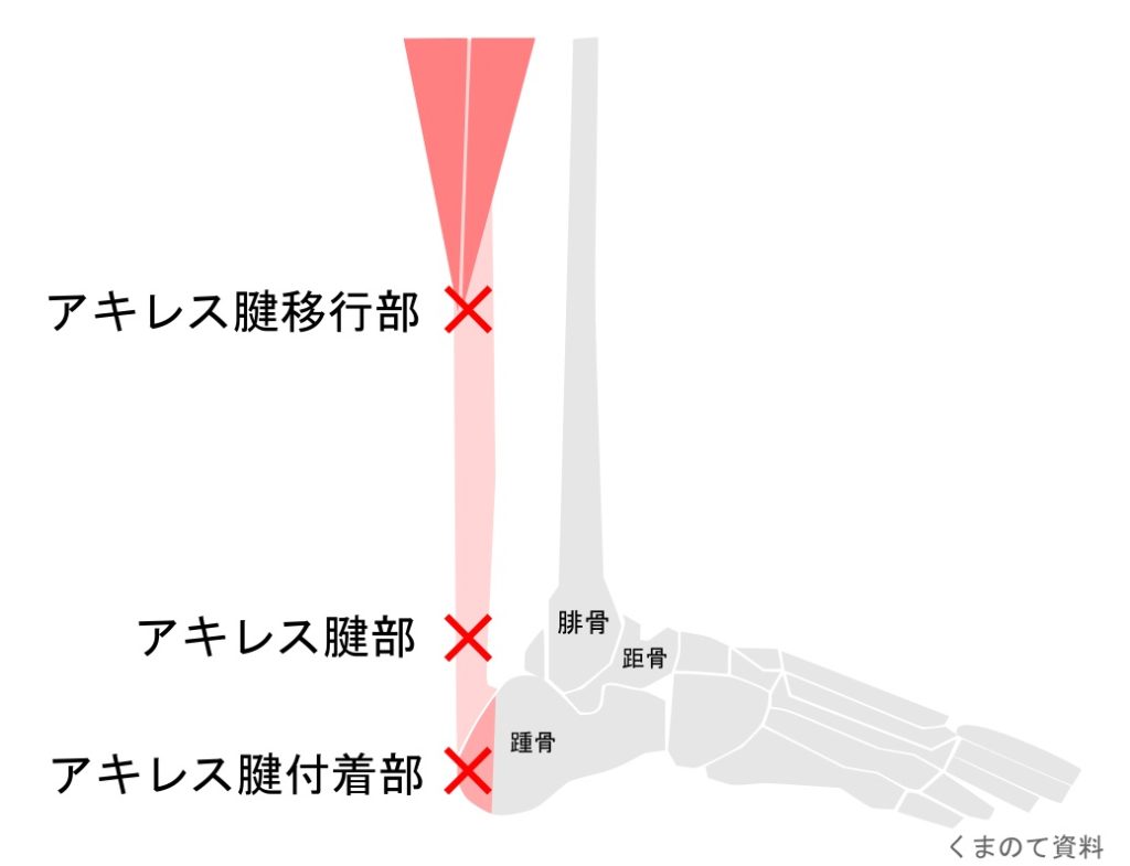 アキレス腱周囲炎イラスト