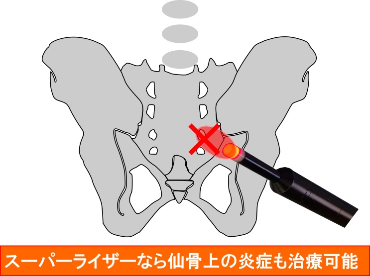 腰痛は仙骨に炎症がある