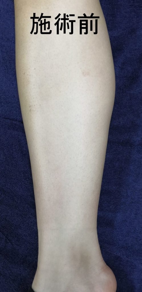 脚のむくみの施術 青葉台駅 くまのて接骨院