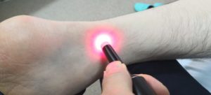 くまのて接骨院のアキレス腱照射