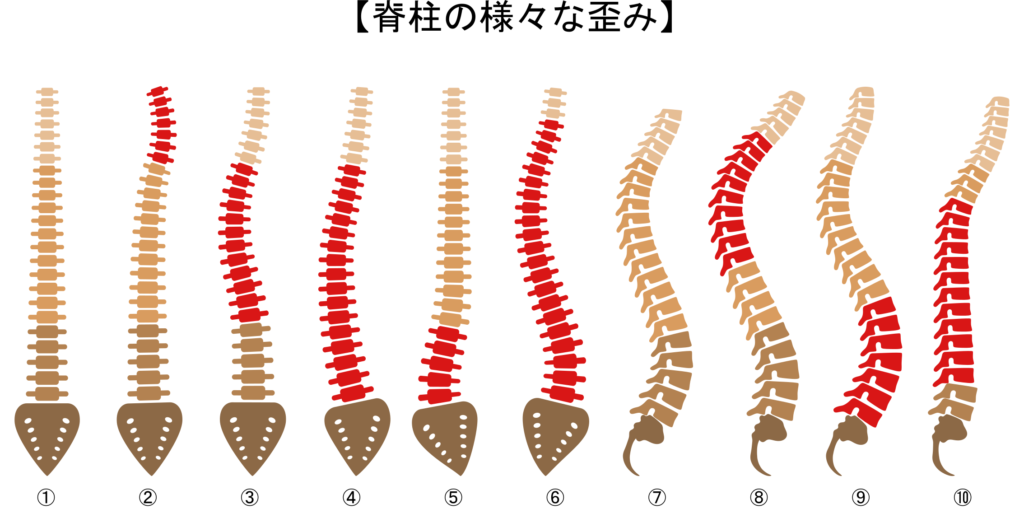 脊柱の歪み