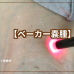 ベーカー嚢腫について
