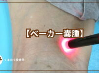 ベーカー嚢腫について