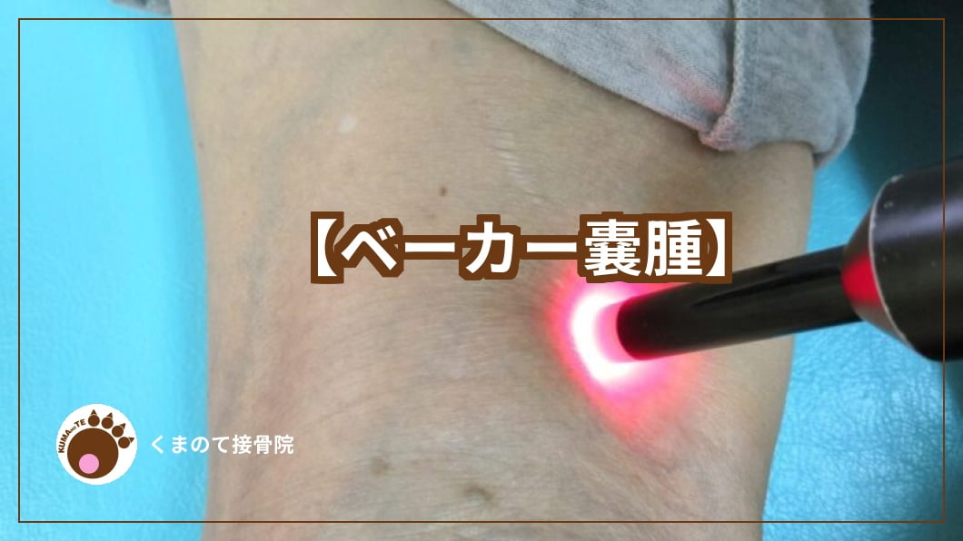 ベーカー嚢腫について