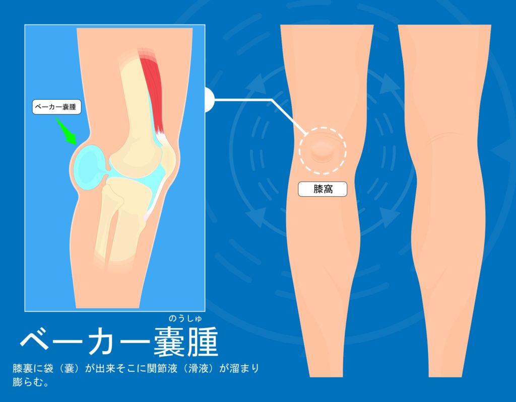 ベーカー嚢腫は膝の裏に袋が出来る疾患