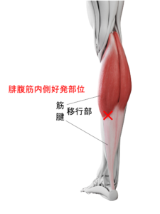 腓腹筋内側肉離れ好発部位