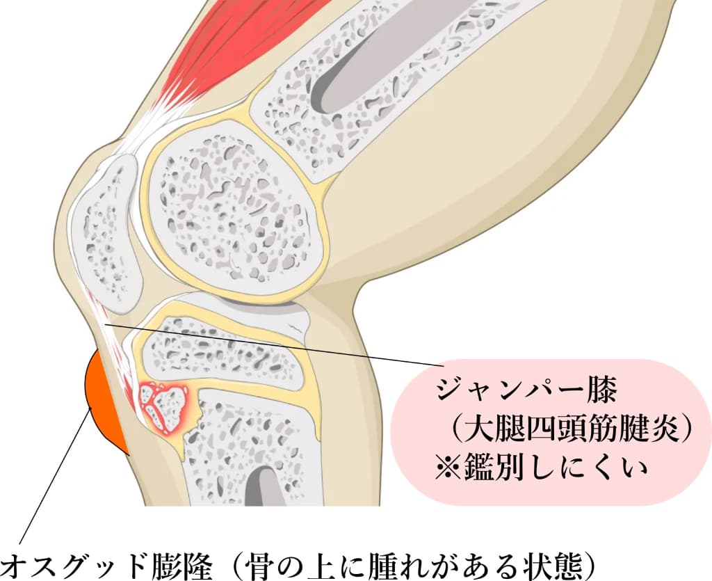 オスグッド病とジャンパー膝の鑑別イラスト