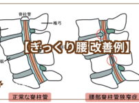 腰椎とぎっくり腰の改善例のテキスト