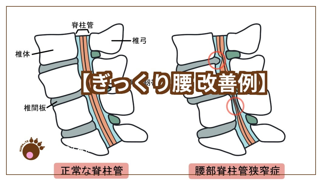 腰椎とぎっくり腰の改善例のテキスト