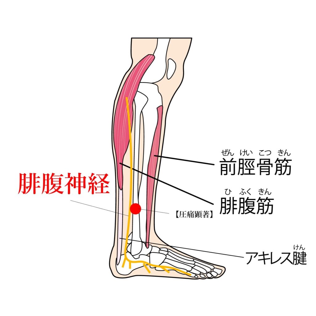 腓腹神経障害マラソン