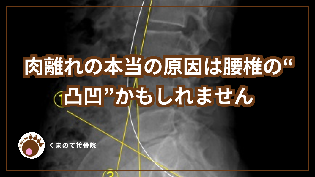 肉離れの本当の原因は腰椎の凸凹かもしれません。