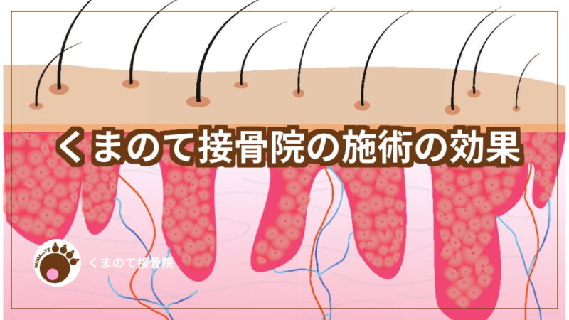 捻挫の腫れのアイキャッチ画像