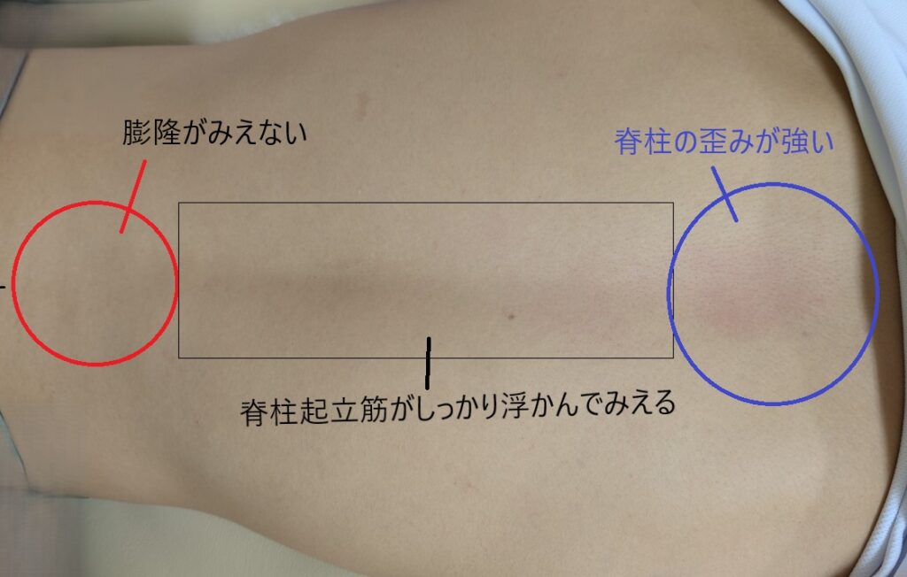 脊柱周囲の調整施術前の背骨の状態の評価